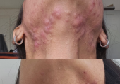 Skin results