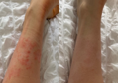 Psoriasis progress