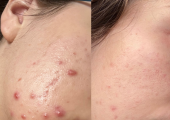 Acne progress