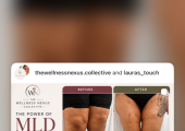 Manual Lymphatic Drainage Lipoedema treatment at Laura’s Touch
