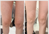 Laura’s Touch MLD fluid retention before and after client