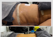 Laura’s Touch Post Op MLD before and after client