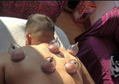 Client had cupping carried out on full back and arms
