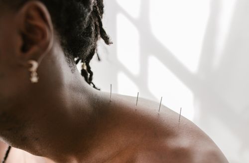 acupuncture needles